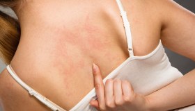 Psoriasi: cos’è, come riconoscerla, cause, cure