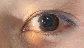 Pterigio: sintomi, diagnosi, cura