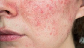 Rosacea: cos’è, cause, trattamenti