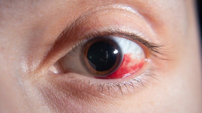 Sangue nell’occhio: cause e rimedi
