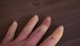 Sclerodermia: cos’è, i sintomi, come curarla