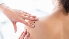 Verruche seborroiche: sintomi, cause e trattamenti