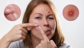 Cisti sebacea: cause, manifestazioni e come curare