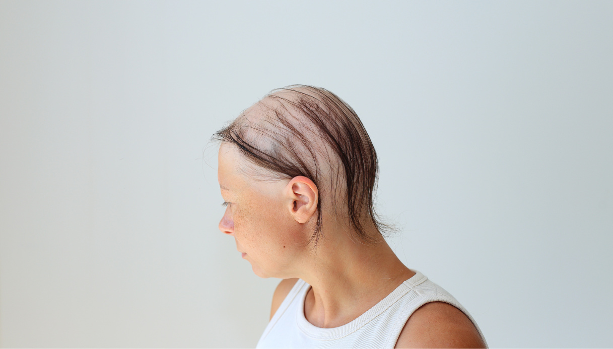 “Ho perso tutti i capelli in una notte”: la giornalista Laura Aprati rompe lo stigma sull’alopecia
