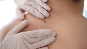 Melanoma e immunoterapia, il tris di farmaci che lo rende più curabile