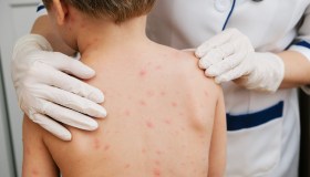 Esantemi nei bambini, come riconoscere l’origine delle macchie sulla pelle e come affrontarle