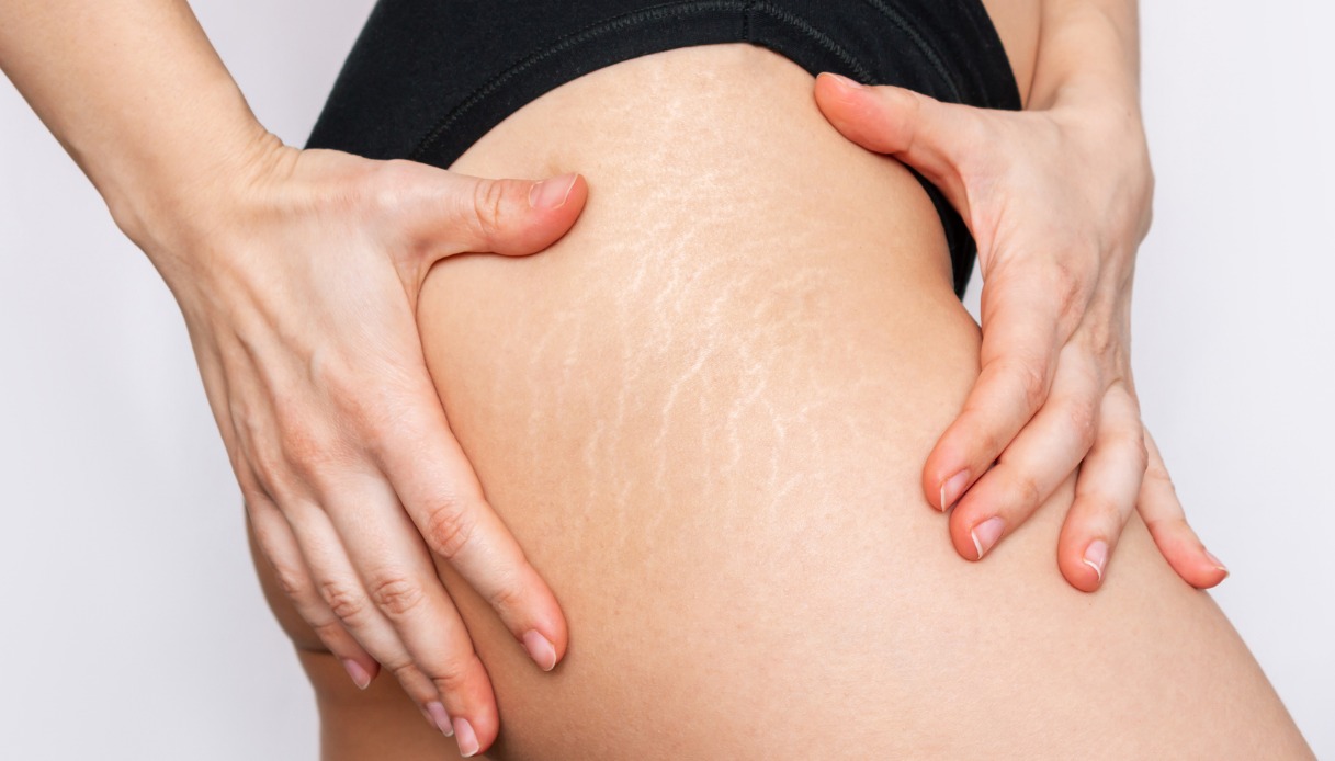 Goodbye stretch marks? Yes, with the anti-stretch mark treatment at a discount