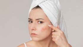 Creme viso per couperose. I migliori prodotti delicati ed efficaci da provare adesso