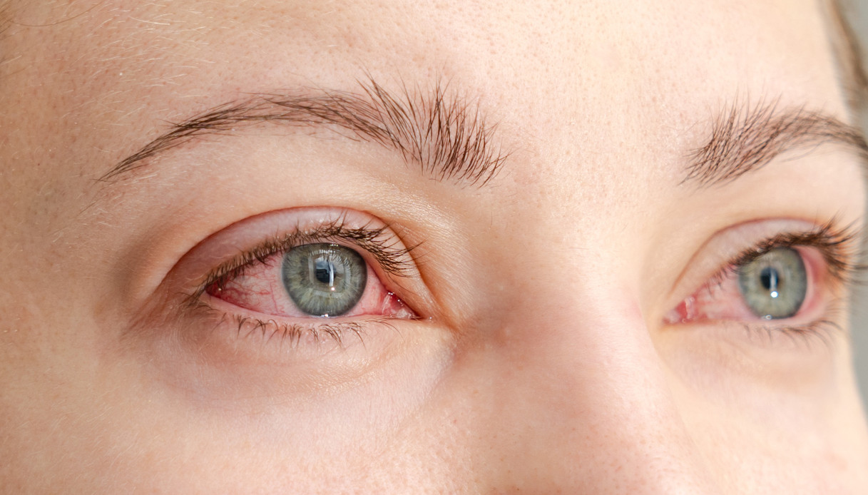 Primavera e benessere oculare, come affrontare le allergie e l’occhio secco