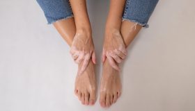 Vitiligine, gestirla meglio e conoscerla per andare oltre i falsi miti