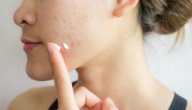 Crema acne e brufoli infiammati: quali funzionano davvero (e come sceglierle)