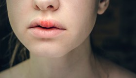 Angioedema ereditario, l’importanza della diagnosi: sintomi e centri di cura
