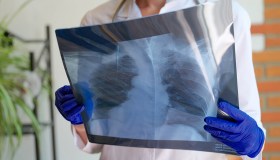 Immunoterapia per tumore al polmone, scoperta mutazione che può aiutare la cura