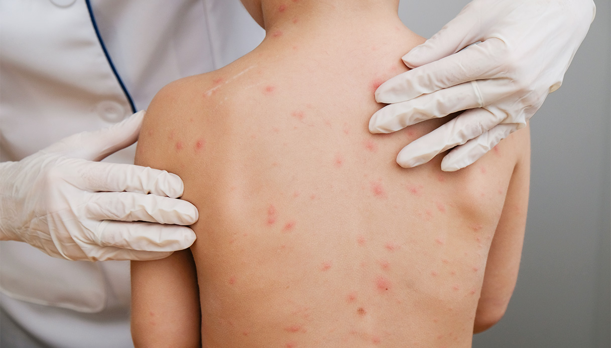 Morbillo: quali sono i sintomi e la diffusione ad oggi in Italia