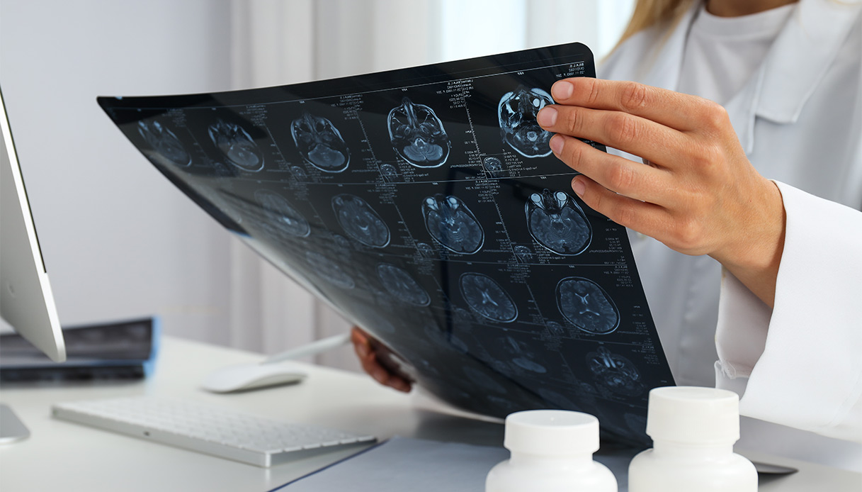 glioblastoma come si manifesta e come si affronta questo tipo di tumore al cervello da Dilei.it glioblastoma come si manifesta e come si affronta questo tipo di tumore al cervello