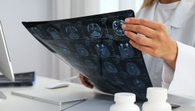 Glioblastoma, come si manifesta e come si affronta questo tipo di tumore al cervello