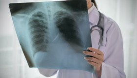 Microcitoma, cos’è e come si riconosce