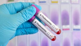 Talassemia, perché nasce, come si manifesta e come si cura