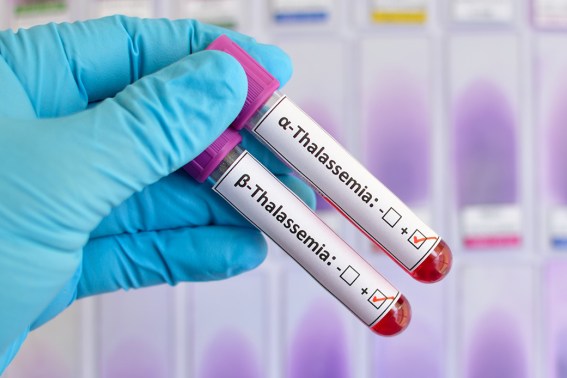 Talassemia, perché nasce, come si manifesta e come si cura