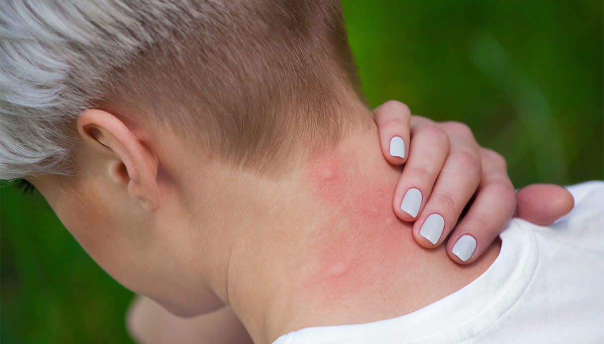 Malaria, cos’è, come si trasmette, come si previene e perché può essere pericolosa