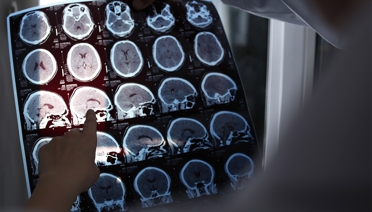 Gliomi e tumori cerebrali, come cambiano le cure con la medicina di precisione