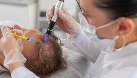 Alopecia, arriva la proteina che può invertire la caduta dei capelli