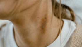 Fuoco di Sant’Antonio e patologie oncologiche, quali conseguenze