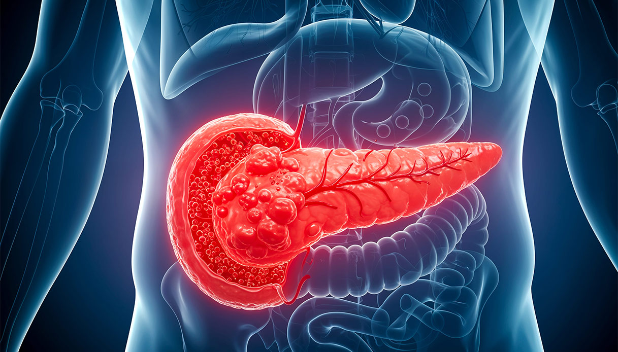 Tumori, come rendere sensibili all’immunoterapia quelli che non rispondono