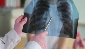 Allarme tubercolosi a Trieste, positivi in 30 studenti. Le rassicurazioni degli esperti, rischi e vaccinazione