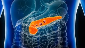 Tumore al pancreas, come diventa resistente ai farmaci. La scoperta dei ricercatori e perché è importante