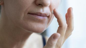 Zona baffetti più scura: i rimedi dell’esperto per prevenire e curare il melasma d’estate
