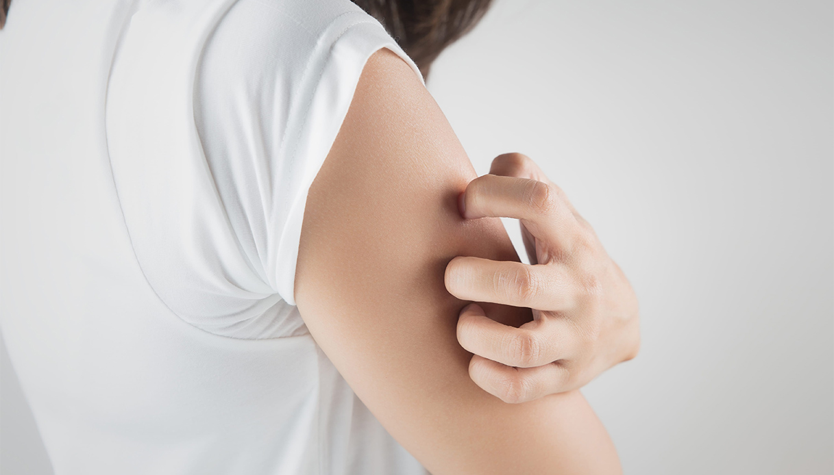 Prurito cronico, quando si parla di Prurigo Nodularis, come si riconosce e si affronta