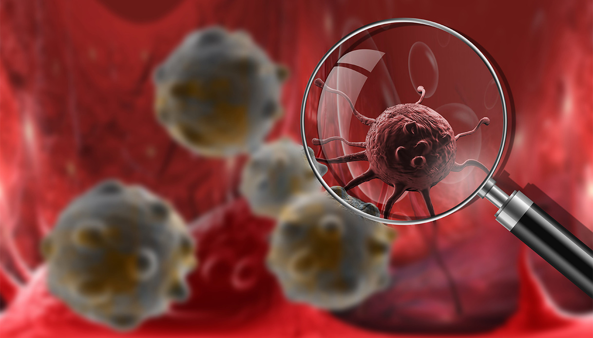 Tumore del pancreas e melanoma, tra farmaci intelligenti e immunoterapia: speranze per cure sempre più efficaci