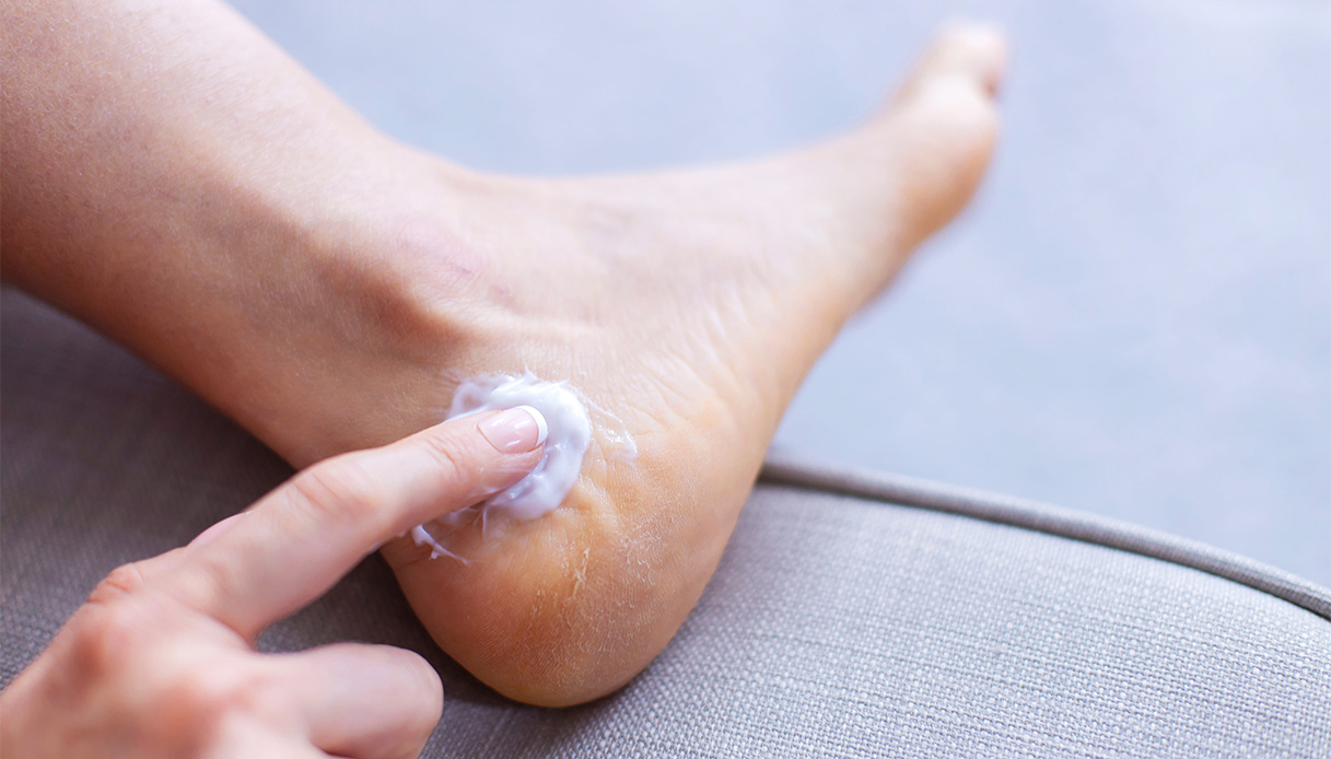 Piedi screpolati, cinque regole per aiutare il benessere della pelle