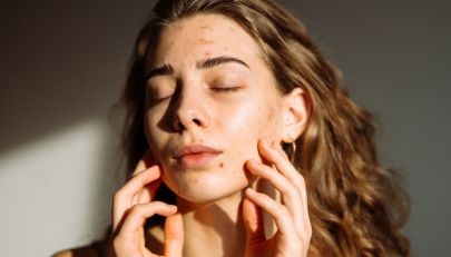Acne in estate, l’alleato naturale da tenere in casa contro i brufoli sotto il sole
