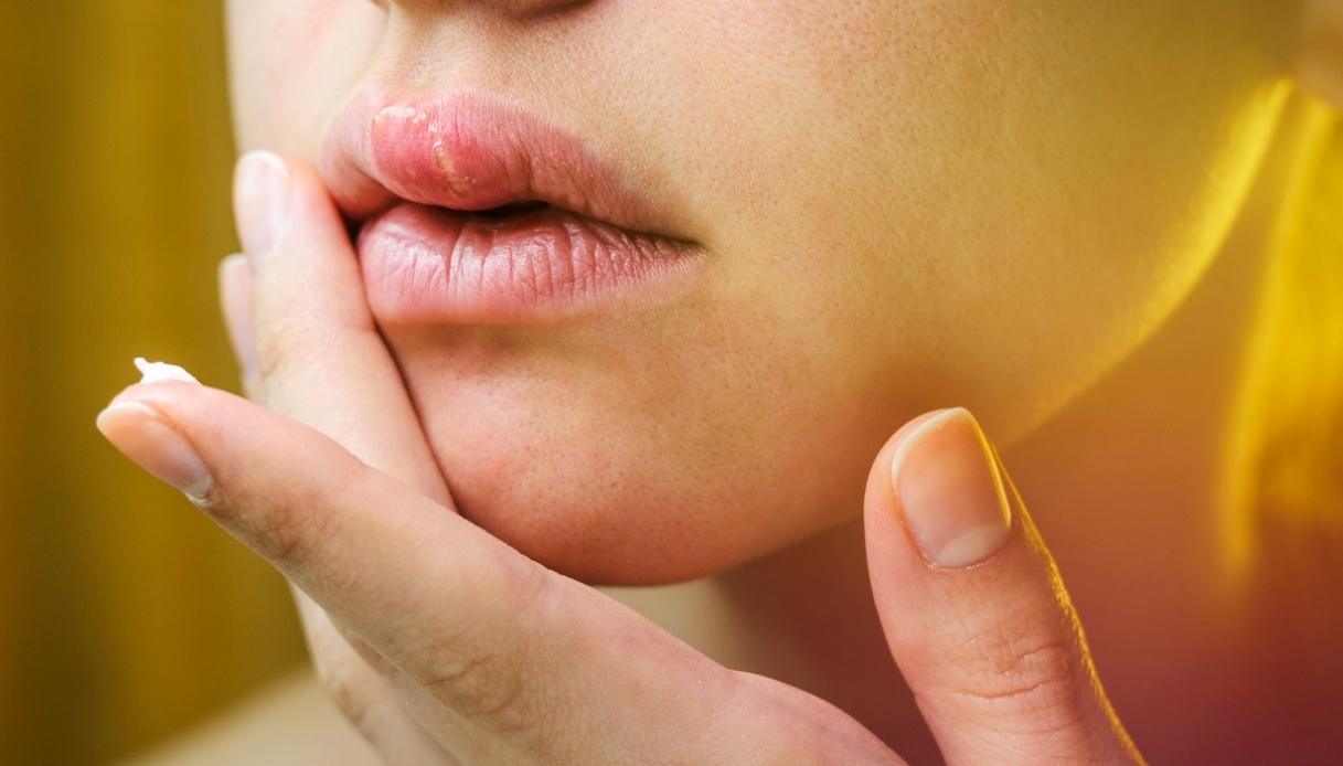 Herpes labiale e prodotti da applicare per contrastarlo e prevenirlo