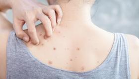 Acne e brufoli sulla schiena: la strategia e i rimedi per eliminare la backne
