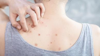 Acne e brufoli sulla schiena: la strategia e i rimedi per eliminare la backne