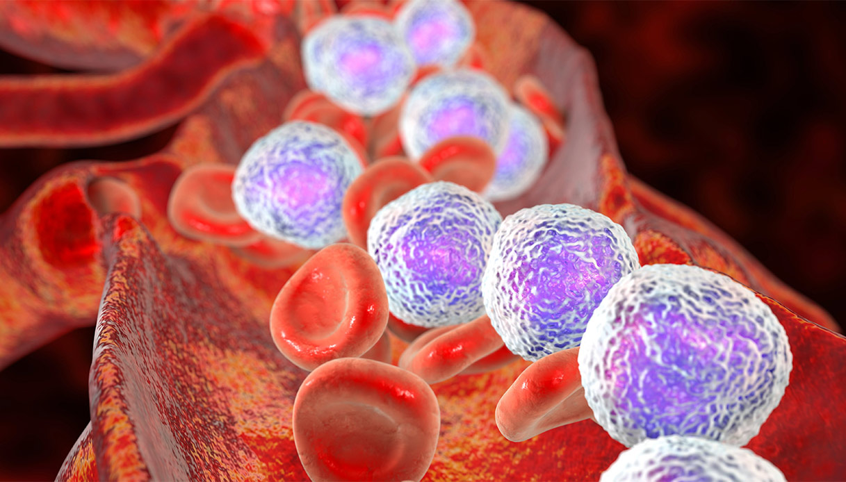 Leucemia linfoblastica acuta, cos’è, chi colpisce e come si affronta
