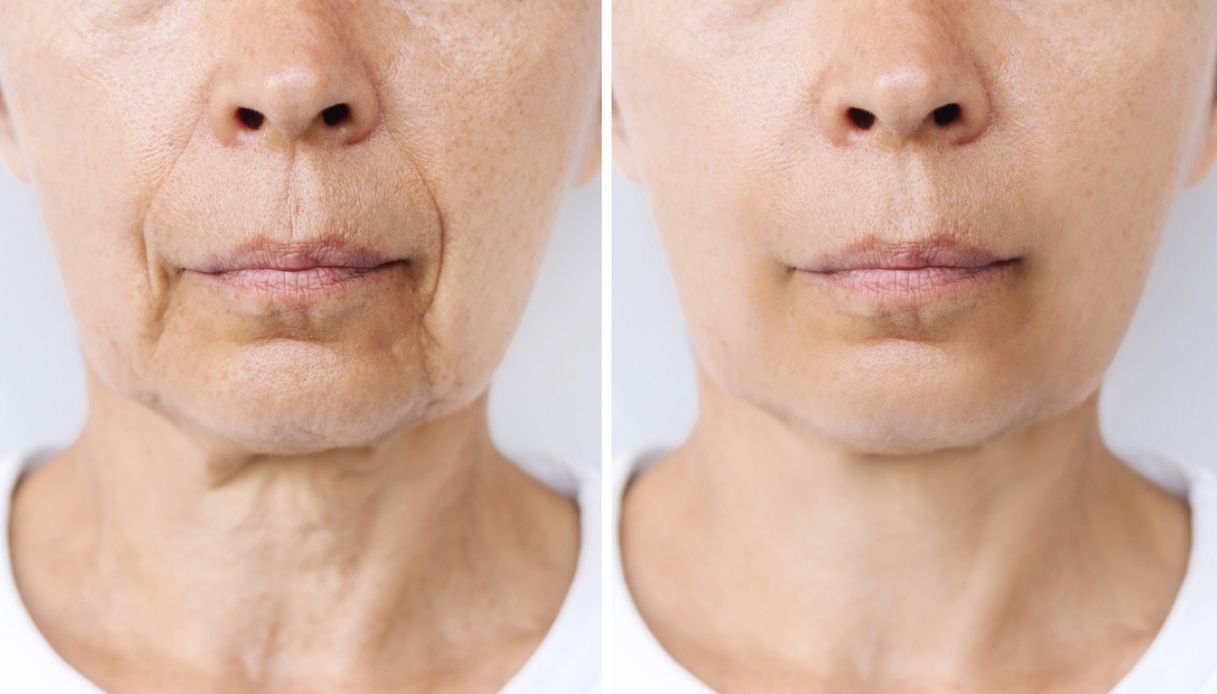 boom di creme contro la faccia da ozempic dopo i farmaci anti obesit224 contrastano la pelle cadente da Dilei.it boom di creme contro la faccia da ozempic dopo i farmaci anti obesit224 contrastano la pelle cadente