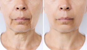 Boom di creme contro la “faccia da Ozempic”, dopo i farmaci anti-obesità contrastano la pelle cadente