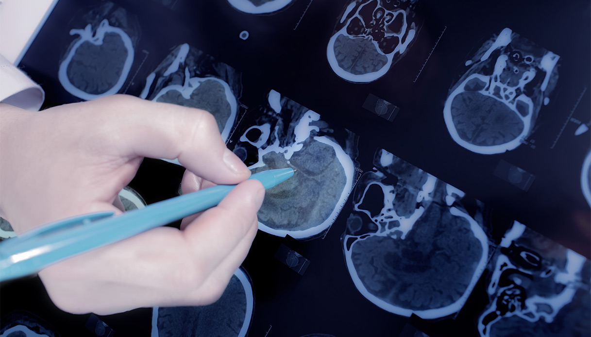 Epilessia, per le forme resistenti ai farmaci una nuova alternativa: cos’è e come funziona la stimolazione epicranica