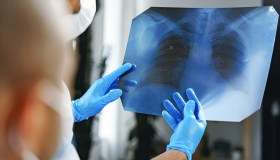 Tumore del polmone, nel microcitoma la “doppia” immunoterapia allunga la sopravvivenza nelle forme estese